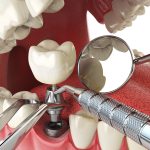 Ultimate Guide To Implant & Cosmetic Dentistry
